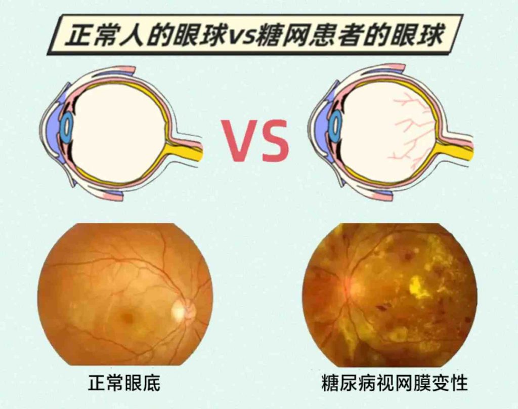 正常人的眼球和糖尿病视网膜病变患者的眼球对比.webp