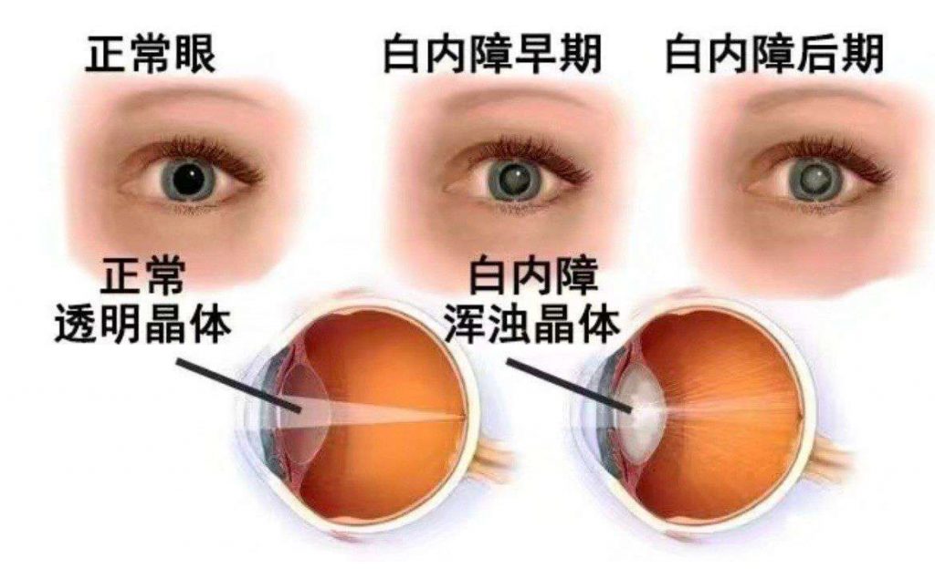 白内障科普图片