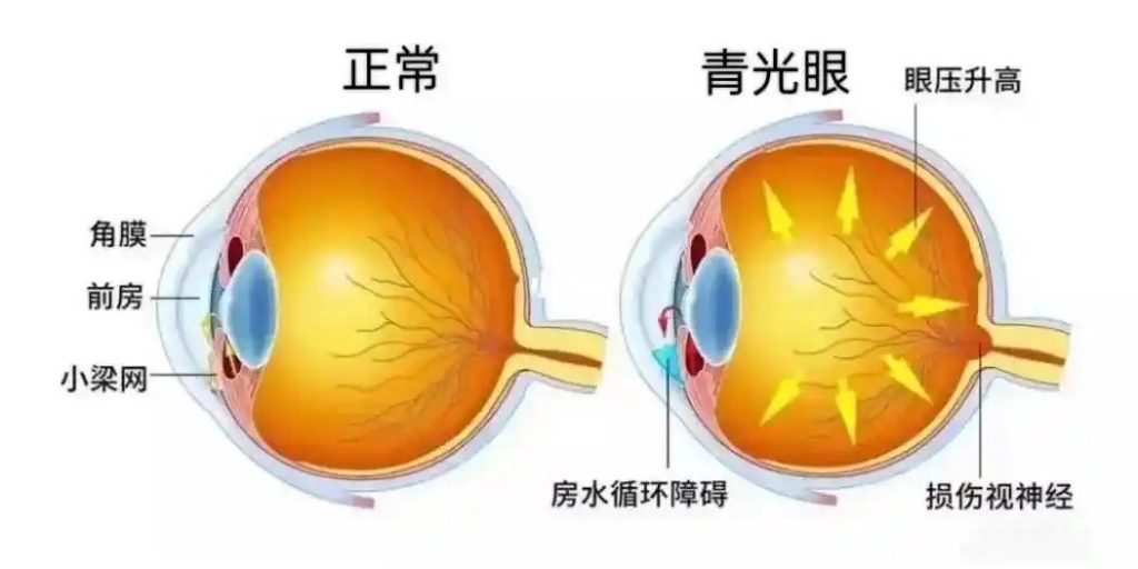 青光眼科普小知识.webp