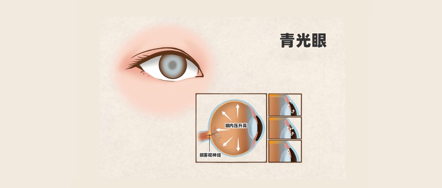 当房水排出不够通畅，眼内压力就会升高，影响到视神经，一旦受损即会发展成青光眼
